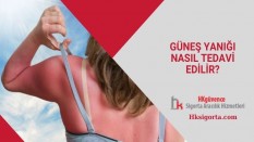 Güneş Yanığı Nasıl Tedavi Edilir?